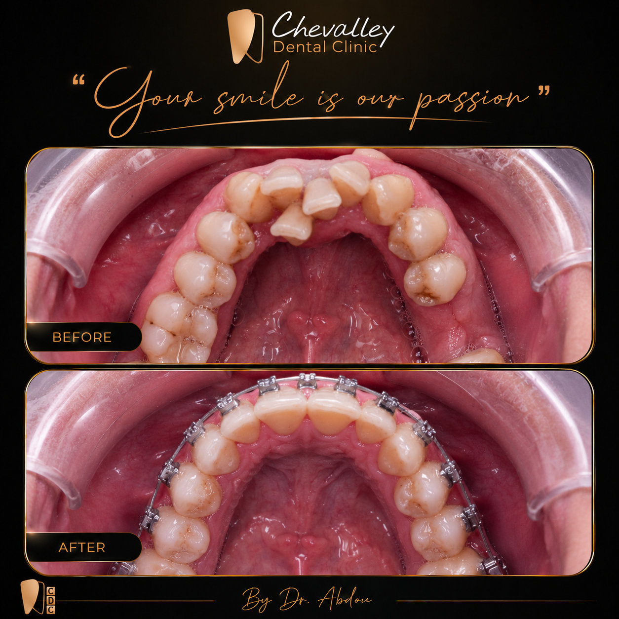 Transformation avant / après 6 — Chevalley Dental Clinic