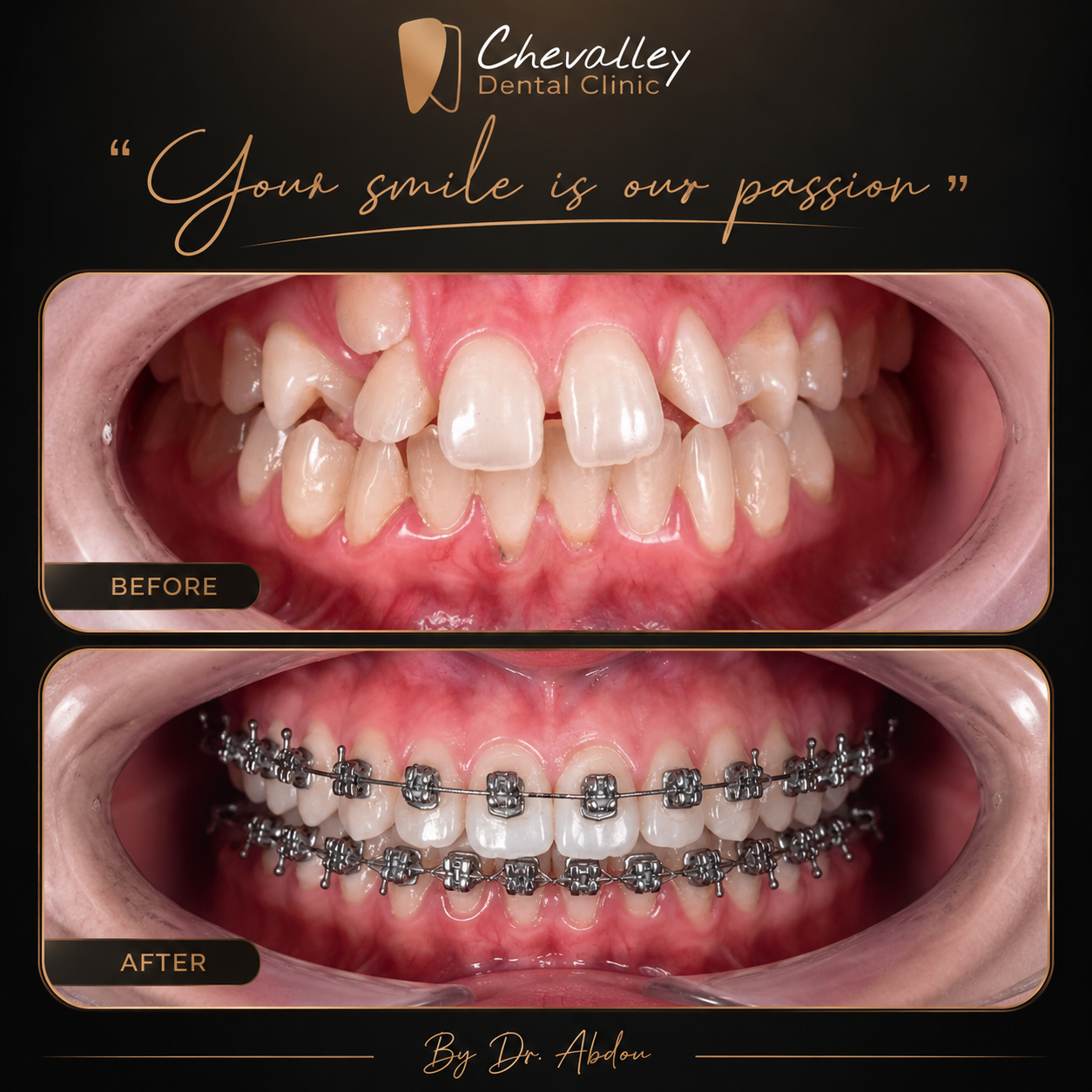 Transformation avant / après 2 — Chevalley Dental Clinic