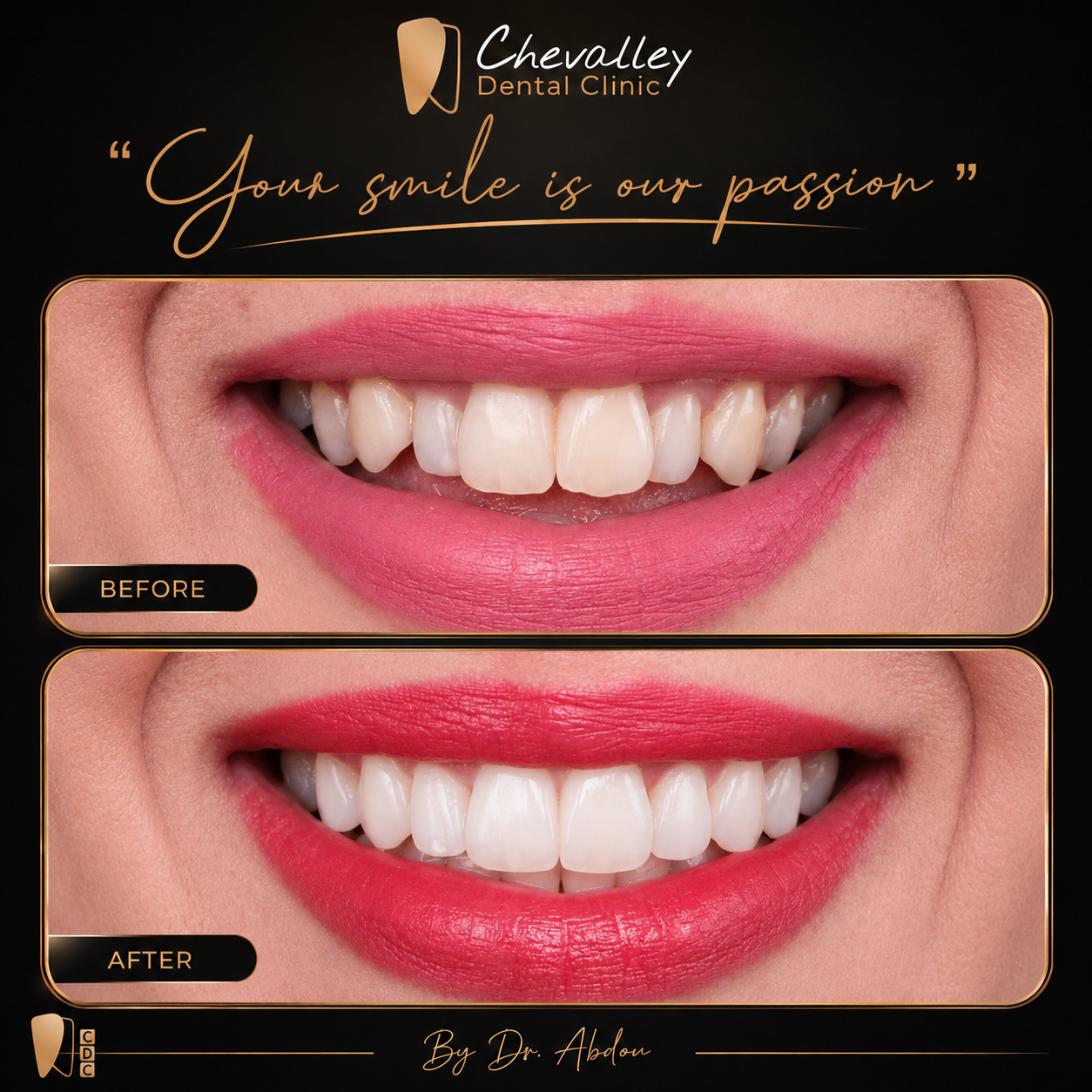 Transformation avant / après 3 — Chevalley Dental Clinic