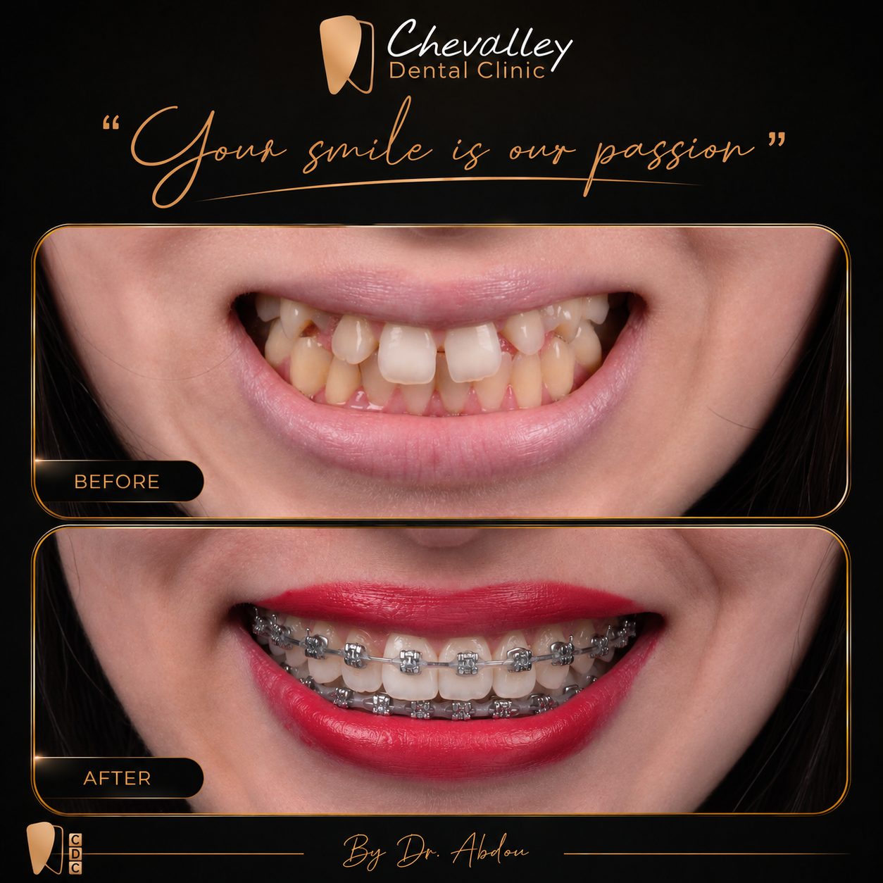 Transformation avant / après 5 — Chevalley Dental Clinic