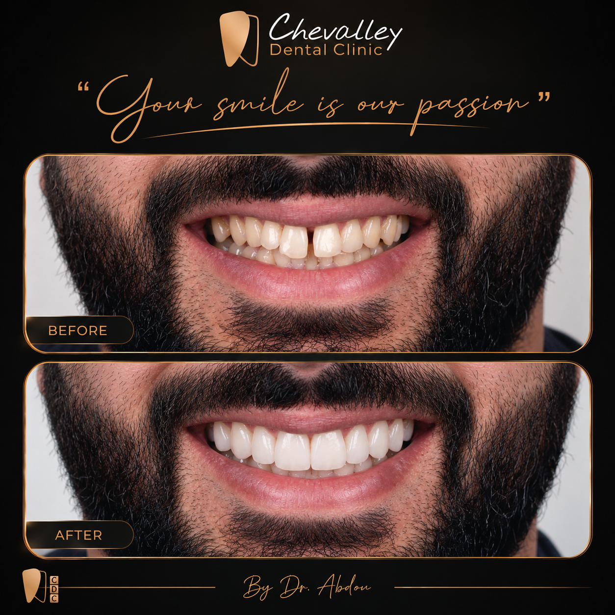 Transformation avant / après 4 — Chevalley Dental Clinic