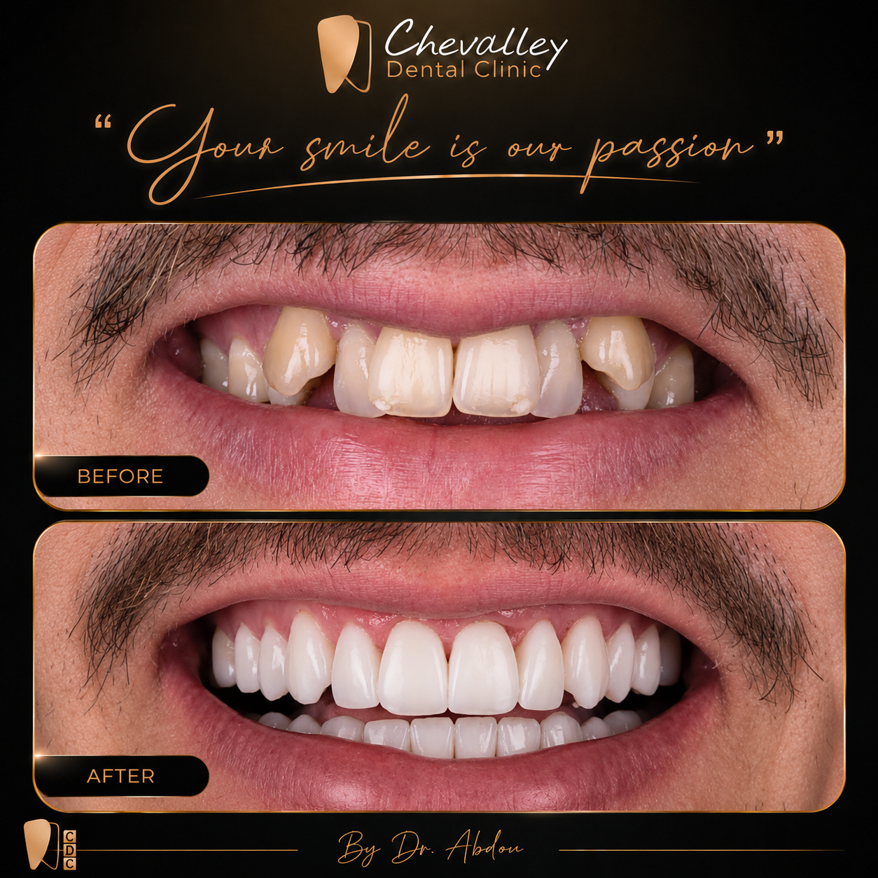 Transformation avant / après 1 — Chevalley Dental Clinic